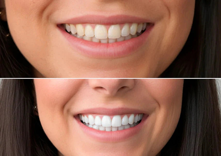 DentaLume Pure Smile-Anında Daha Beyaz Dişler