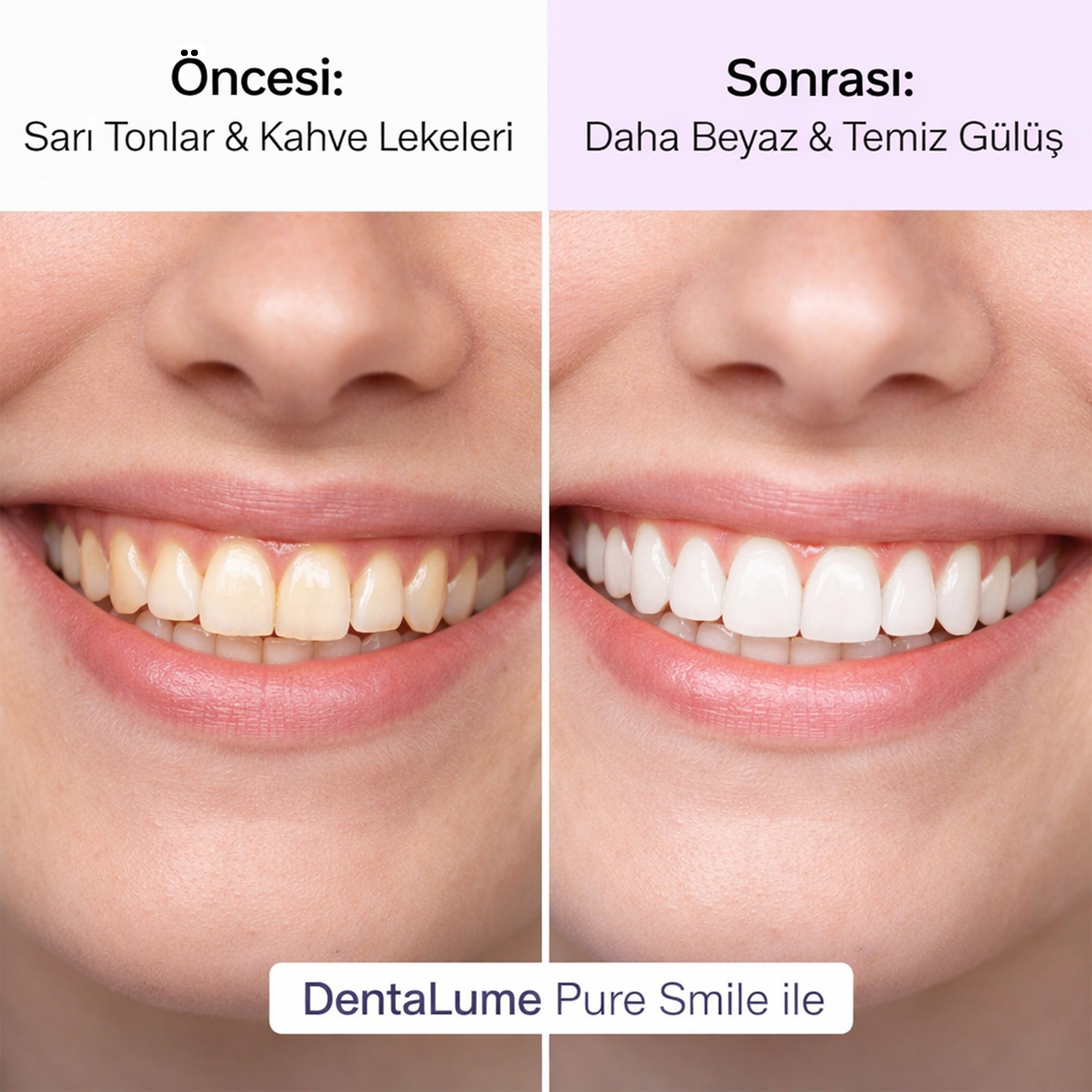 DentaLume® Pure Smile-Evde Anında Daha Beyaz Dişler