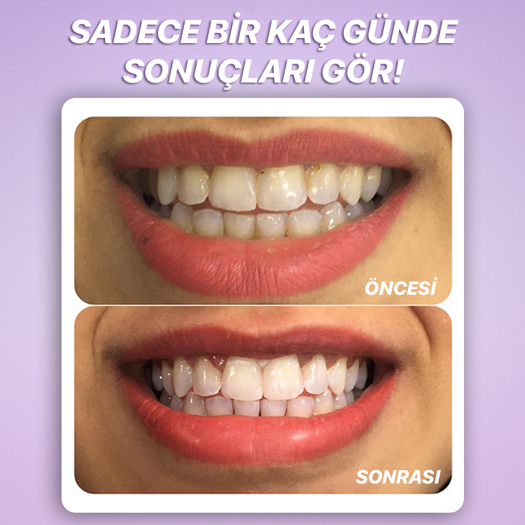 DentaLume Pure Smile-Evde Anında Daha Beyaz Dişler