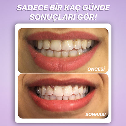 DentaLume Pure Smile-Evde Anında Daha Beyaz Dişler