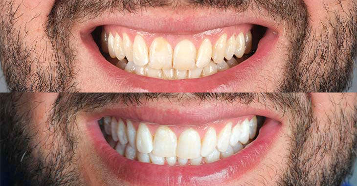 DentaLume Pure Smile-Anında Daha Beyaz Dişler